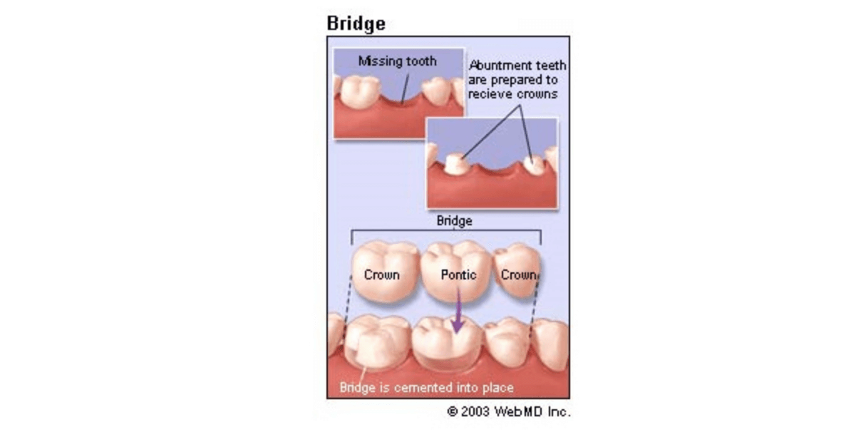Bridge Option Diagram