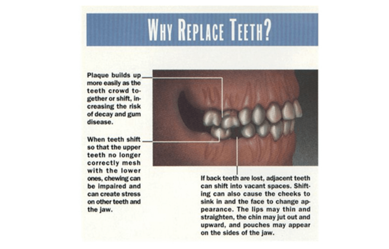 Diagram - why we replace teeth