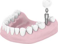 dental implants in Thousand Oaks