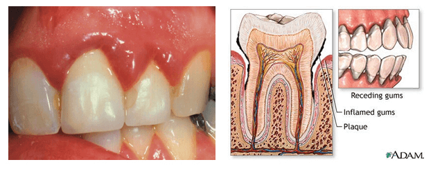 Gingivitis