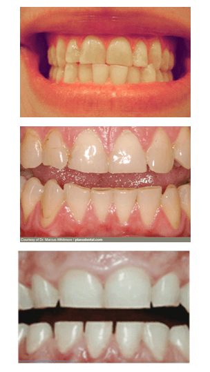 Signs of teeth grinding.