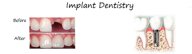 Dental Implants