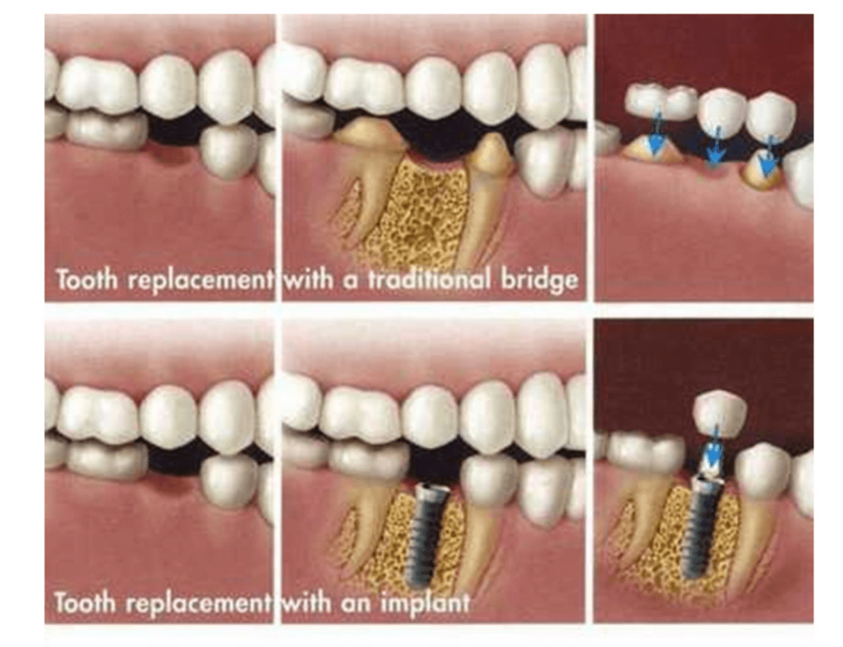 Implant Option Diagram