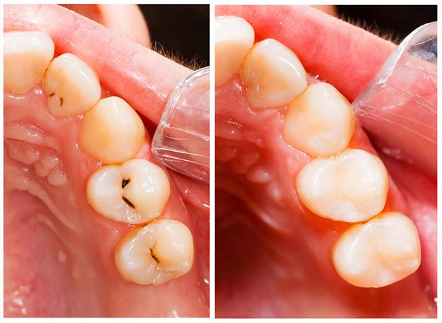 Comparison of Mercury Free Composite and Mercury fillings