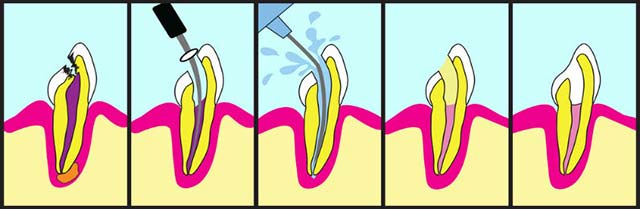 Root Canal Process