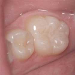 Dental Sealants applied to posterior teeth