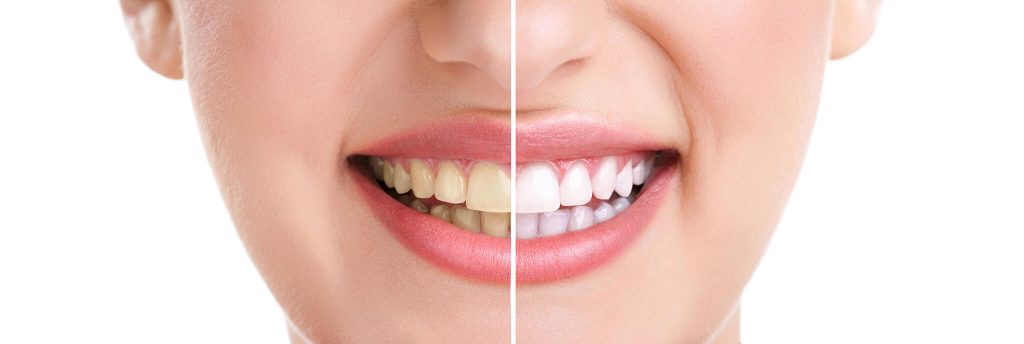 Before and After Teeth Whitening