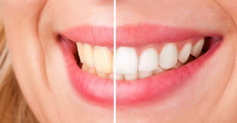 Teeth Whitening in Thousand Oaks