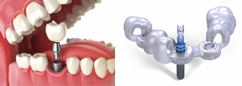 Guided Dental Implant Diagram