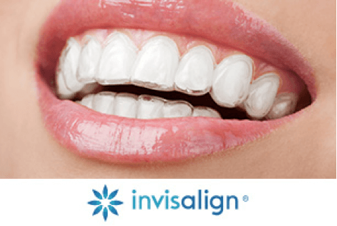 Invisalign Braces - Invisible Braces for a Beautiful Smile