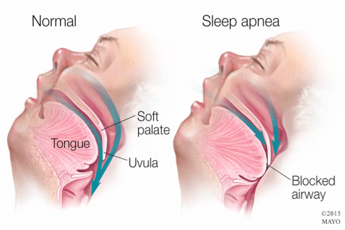 Sleep Apnea Diagram