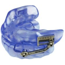 Example of a Sleep Appliance for help with Sleep Apnea